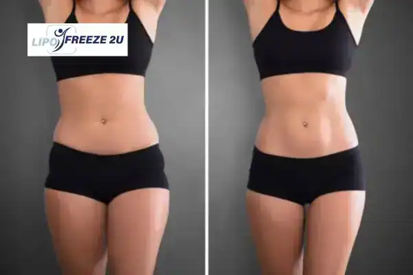 How Can LIPO FREEZE 2U Support Your Post-Pregnancy Body Recovery Glasgow?