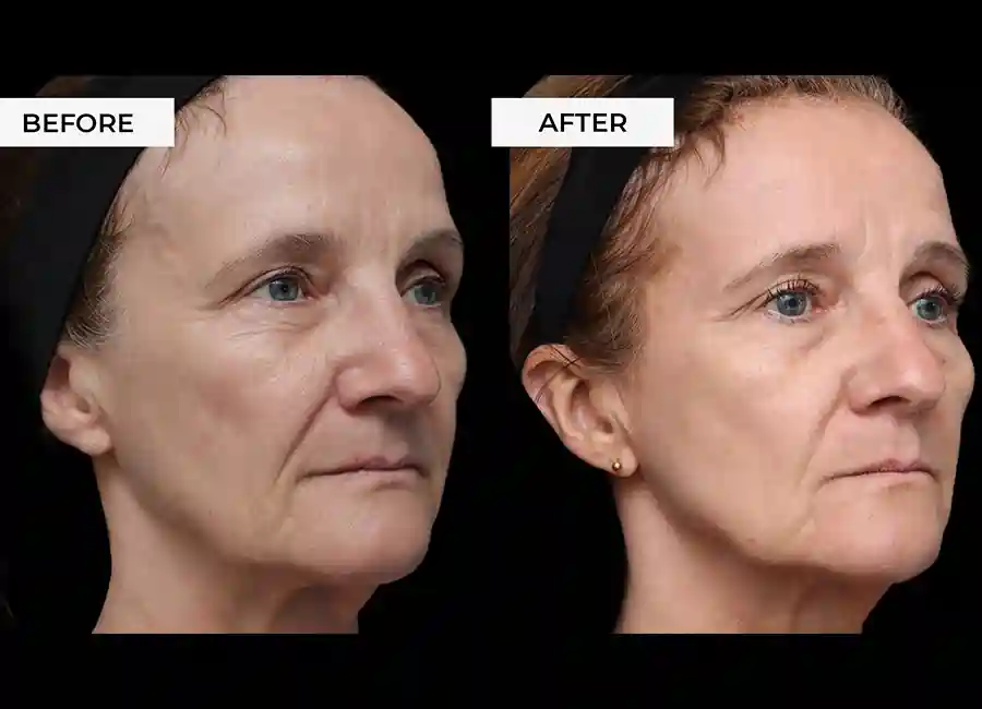 How Many RF Microneedling Sessions Will You Need to See a Difference Glasgow?